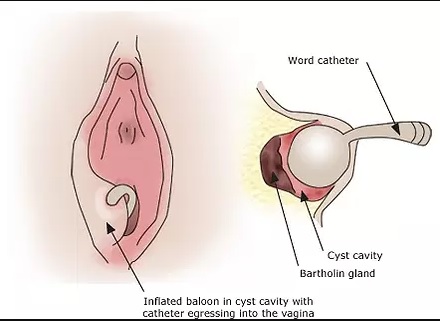BARTOLIN ABSCESS