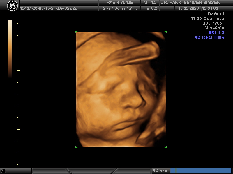 Pregnancy Monitoring and the Importance of Ultrasound