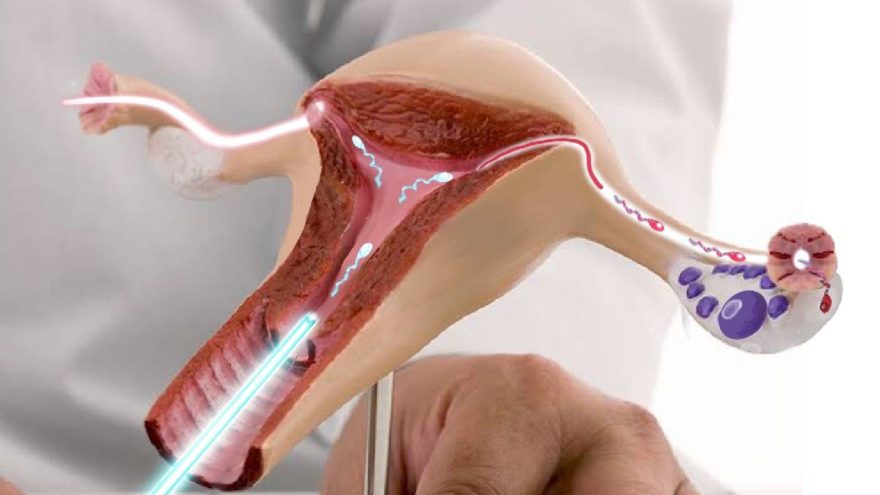 Pregnancy Through Insemination (IUI)
